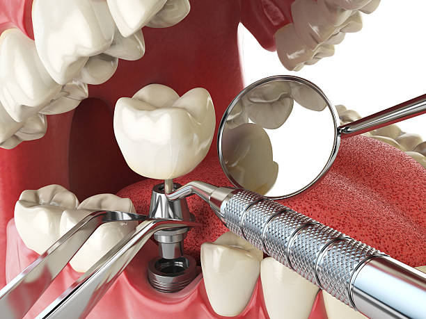 Best Emergency Dentist for Lost Fillings or Crowns in Uintah, UT